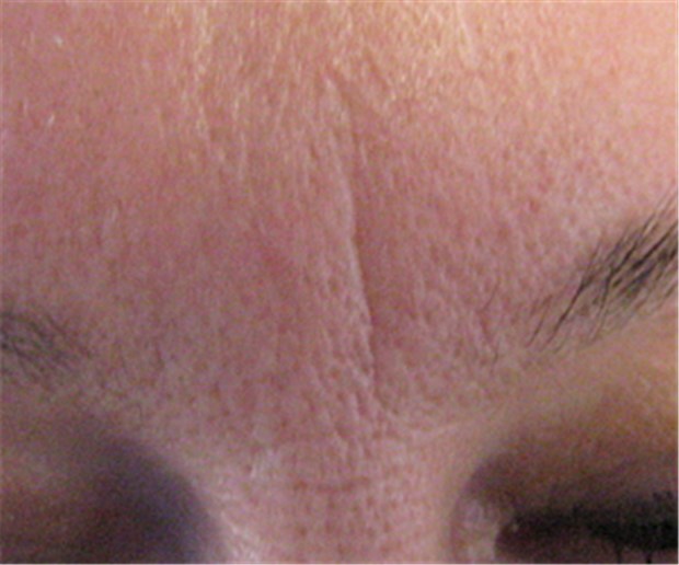 Wenn Facelifting blind macht Gabellafalte: Das Lifting kann schlimme Folgen haben.