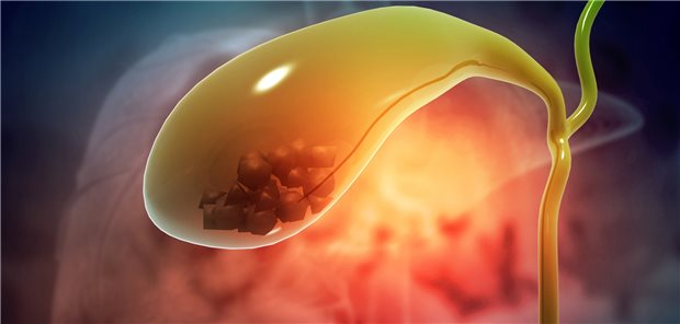 Gallenblase mit Gallensteinen: Das Risiko für Gallenblase-Probleme ist bei einer Therapie mit GLP-1-Rezeptoragonisten offenbar erhöht.