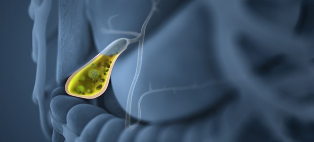 NOTES ist aus dem Gröbsten raus Gallensteine: Bei Patientinnen etabliert sich zunehmend die NOTES.