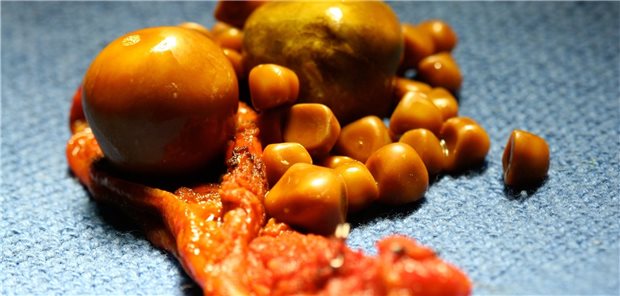 Gallensteine. Die Gallensteinprävalenz liegt in Deutschland bei circa 30 Prozent. Wer sollte operiert werden?