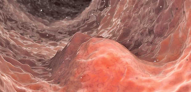 Therapie verlangt viel fachübergreifende Kooperation Gastrointestinale Stromatumoren (GIST) machen 20 bis 35 Prozent der Weichteilsarkome aus.