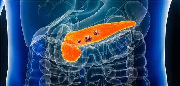 Schematische Darstellung von gastrointestinale Tumoren