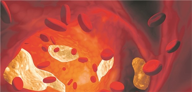Evolocumab schützt vor Herzinfarkt und Apoplexie Gefäß-Modell mit LDL-Partikeln und Erythrozyten.