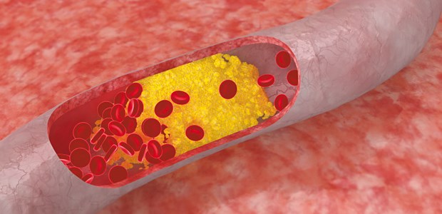Neuer Therapieansatz zur Cholesterinsenkung Gefäß verstopfendes Cholesterin-Plaque: Gibt es bald eine neue Wirkstoffklasse zur LDL-Senkung?