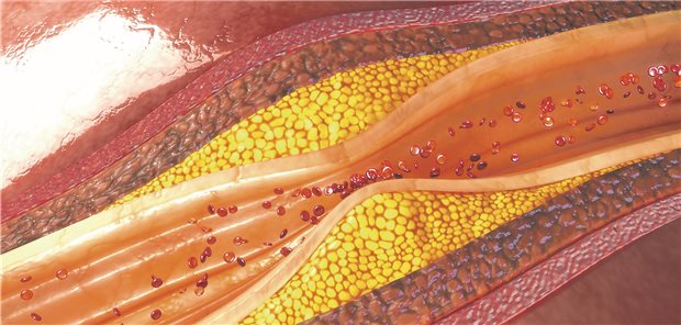 Gefäßablagerungen: Die Plaquezusammensetzung scheint das Atherosklerose-Risiko wesentlich zu beeinflussen.