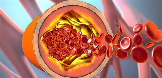 Gefäßschutz: Bei Patienten, die bereits einen krytogenen Schlaganfall erlitten haben, ist die Antikoagulation mit NOAK eine Option zur Rezidivprophylaxe.