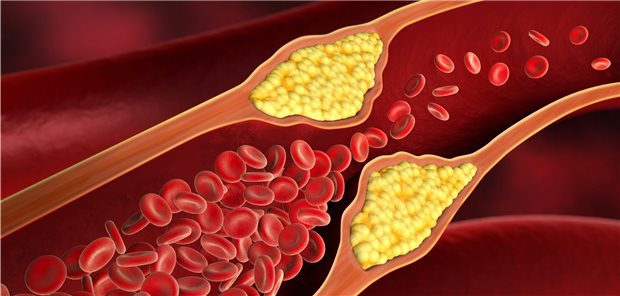 Gefäßstenose: Eine signifikante Atherosklerose in Abwesenheit von Koronarkalk ist möglich.