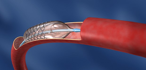Zwei Verfahren erleichtern die Diagnose Gefäßstent: Wie sich Stenosen leichter erkennen lassen, haben Berliner Forscher untersucht.
