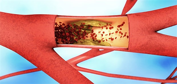 Kardiologen kritisieren Sender ARTE wegen "gefährlicher Desinformation" Gefäßverengung durch Plaques. Vor allem das LDL-Cholesterin gilt als Risikofaktor, dass es zu solchen gefährlichen Ablagerungen kommt.