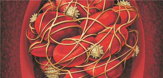 Thrombus im Gefäß (künstlerische Darstellung)