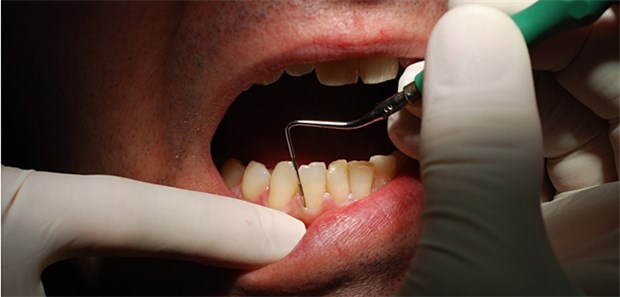 Wann Antibiotika bei Dentaleingriffen? Gefahr für Patienten beim Zahnarzt mit Antibiotika bannen - möglich oder nicht?