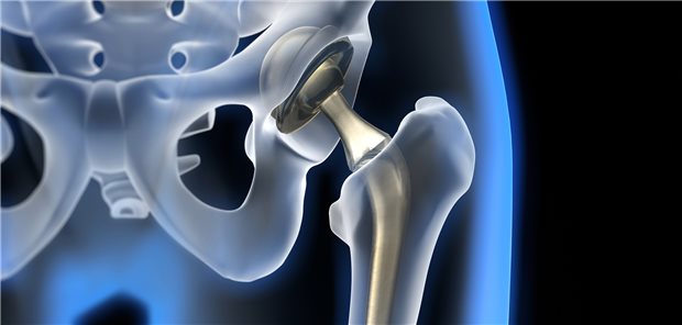 Gefahren für die Hüftendoprothese: Ein geschwächter Muskel-, Band- und Sehnenapparat erhöht die Sturzneigung und die Gefahr einer Luxation des Kunstgelenks steigt.
