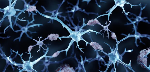 Amyloid Ablagerungen an Neuronen. 