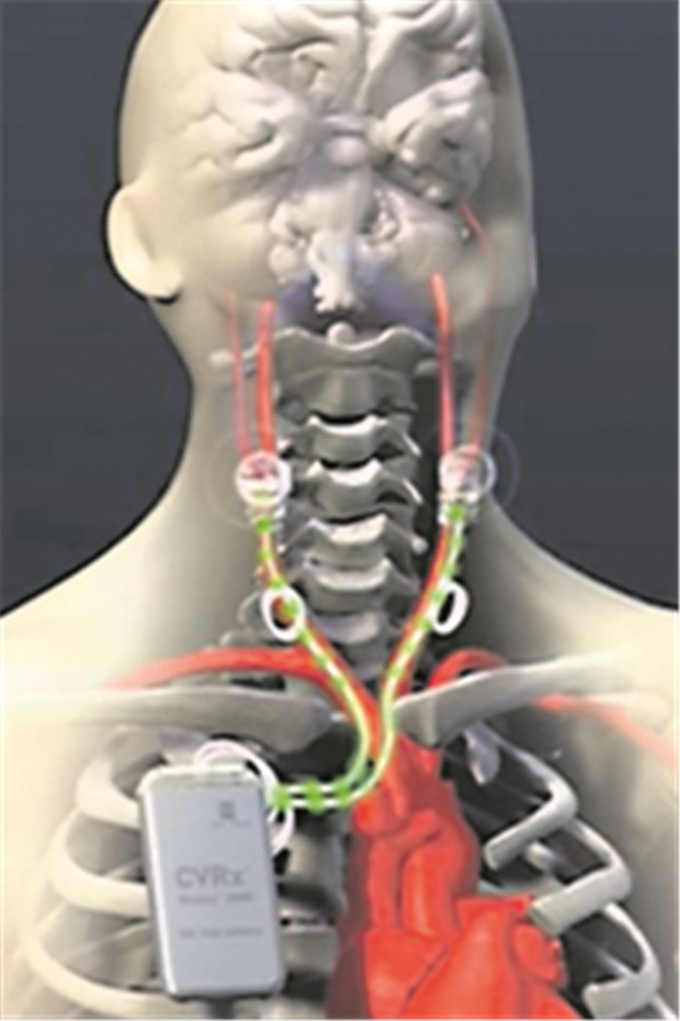 Gut gegen Bluthochdruck Gegen therapierefraktäre Hypertonie hat sich die Stimulation der Barorezeptoren im Carotissinus mit einem infraklavikulär eingesetzten Schrittmacher als wirksam gezeigt.