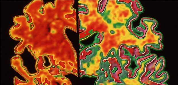 Gehirn eines Alzheimer-Patienten (links) im Vergleich mit dem Gehirn eines Gesunden.