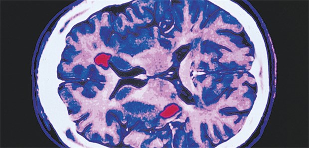 Gehirn mit MS-Läsionen: Medikamente senken die jährliche Schubrate.