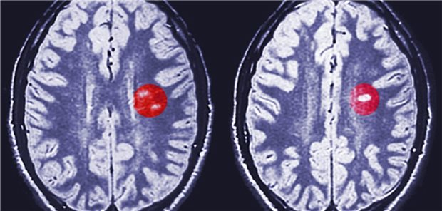 Gehirn mit MS-Schäden: Haben Immunmodulatoren Einfluss auf den COVID-19-Verlauf? 