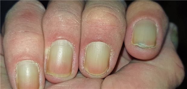 Gelbe Fingernägel – ein leicht übersehener Hinweis auf eine seltene Erkrankung.
