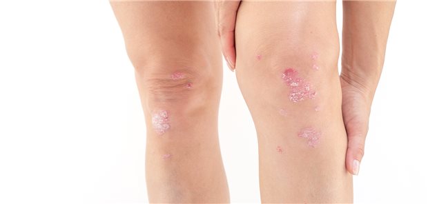 Gelenkbefall mit Schwellung im linken Knie.