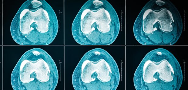 Horizontale Schnitte eines Computertomogrammes des linken Knies.