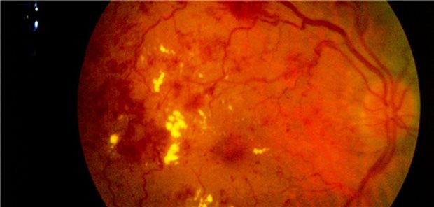 Aufnahme der Netzhaut eines Patienten mit diabetischer Retinopathie.