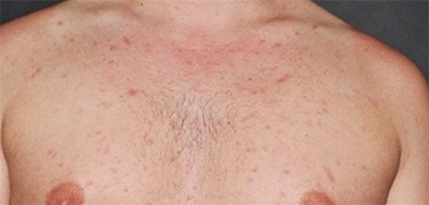 Hautausschlag bei hiv