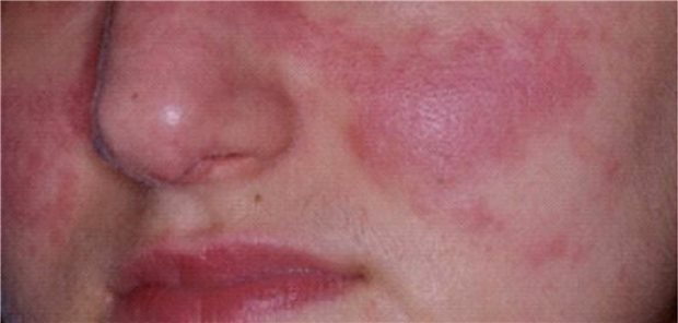 Gerade Patienten mit Systemischem Lupus erythematodes profitieren erheblich von einer Therapie mit Hydroxychloroquin.