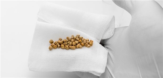 Eine Hand hält mehrere Gallensteine