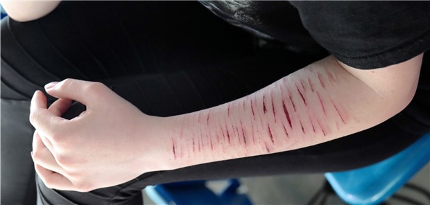 Suizidrisiko nach Selbstverletzung extrem hoch Geritzter linker Unterarm: Auch ein Anzeichen für ein möglicherweise erhöhtes Suizidrisiko.