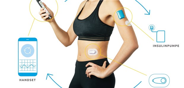Künstliches Pankreas punktet im Alltag Geschickte Kombination: Ein Sensor zur kontinuierlichen BZ-Messung in Verbindung mit einer Pumpe, die anhand der Echtzeit-Glukosewerte automatisch die Insulinabgabe steuert. So entsteht ein künstliches Pankreas. (hier demonstriert am Beispiel Dialoop)