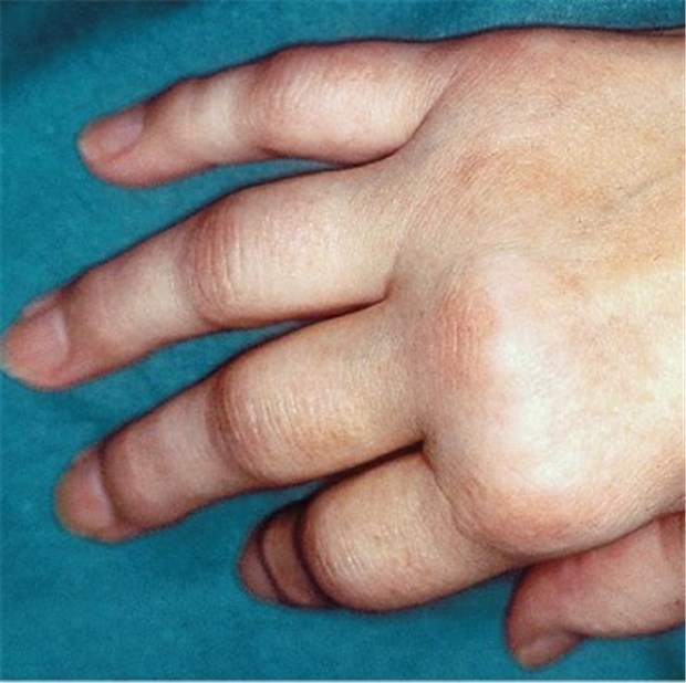 Rheuma erhöht Fehltage bei der Arbeit um das Fünffache Geschwollene Fingergrundgelenke bei Rheumatoider Arthritis.
