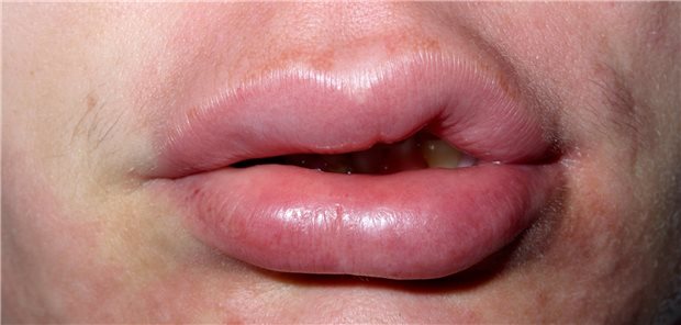Lippen geschwollene How to