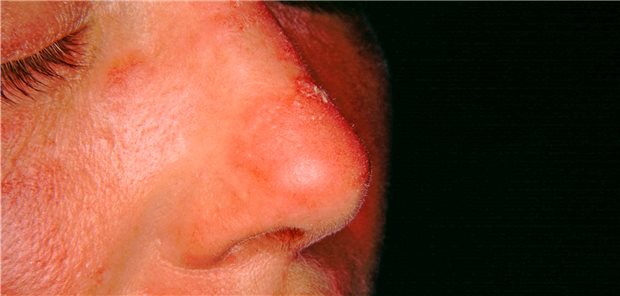 Gesichtserythem: ein besonders charakteristischer Befund bei Patienten mit Lupus erythematodes.