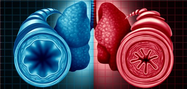 Gesunder (links) und verengter Bronchus bei Asthma: Als Therapieziel bei Asthma gilt aktuell die Remission. Sie setzt voraus, dass das Asthma über einen Zeitraum von mindestens zwölf Monaten vollständig kontrolliert ist.