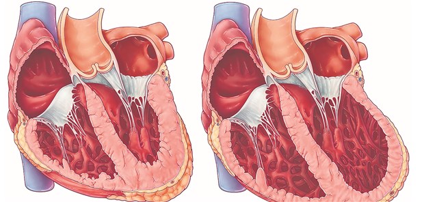 Gesundes Herz (links) im Vergleich zur dilatativen Kardiomyopathie (rechts).
