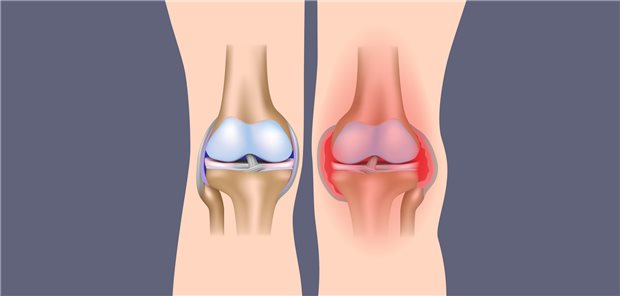 Gesundes Kniegelenk und Knie mit Hämarthrose bei Hämophilie: Zwei neue Medikamente können die Therapie deutlich verbessern.
