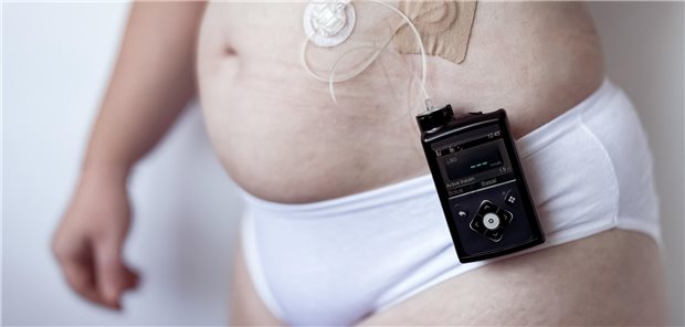 Person mit Insulinpumpe und Blutzuckermessgerät für das Diabetesmanagement.