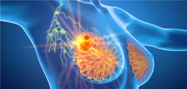 Giacomo Montagna und seine Mitforschenden resümieren, dass die Ergebnisse der Kohortenstudie nahe legen, dass frühe axilläre Rezidive nach Auslassen einer Axilladissektion bei Personen, deren Brustkrebs nach NAC zu ypN0 konvertiert ist, sehr seltene Ereignisse sind und, dass für diese Patientengruppe es wahrscheinlich möglich sei, auf die Axilladissektion zu verzichten, wenngleich dies noch mit einer längeren Nachbeobachtungszeit bestätigt werden müsse.