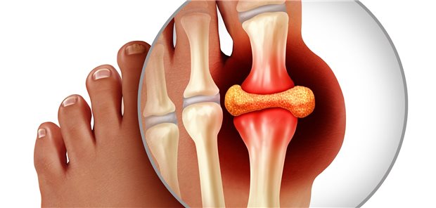 Weniger Gicht bei SGLT-2-Hemmer-Therapie: Gelenkentzündung durch abgelagerte Harnsäurekristalle. 