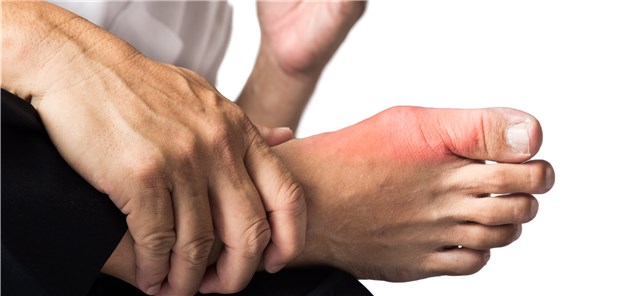 Gichtanfall? Dann sollte der Harnsäurespiegel erst nach Abklingen der akuten Symptome kontrolliert werden.