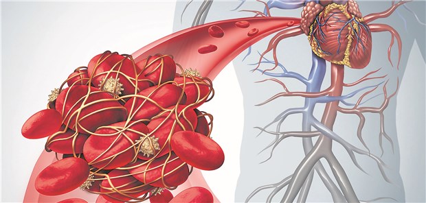 Gilt es als paradoxen unerwünschten Effekt einer Heparin-Therapie zu verhindern: Eine Thrombose.