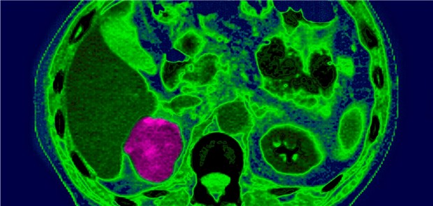 Gleich in zwei Phase-III-Studien lebten Patienten mit fortgeschrittenem Nierenzellkarzinom länger progressionsfrei mit Antiangiogenese plus Immuntherapie im Vergleich zur Sunitinib-Monotherapie.