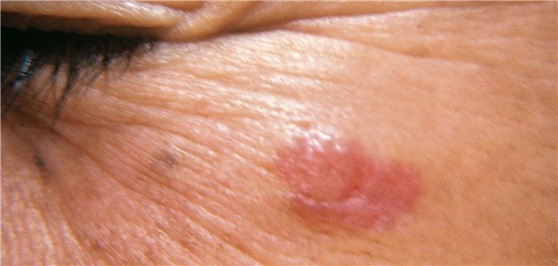 Granulome können sich nach Injektion von Füllmaterial zur Gewebeaugmentation bilden.