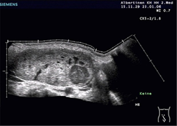 Endometriose erhöht Risiko für ein Ovarialkarzinom Großes, überwiegend solides Ovarialkarzinom