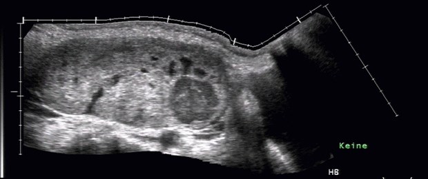 Bevacizumab bremst Progression bei Ovarial-Ca Großes, überwiegend solides Ovarialkarzinom rechts.