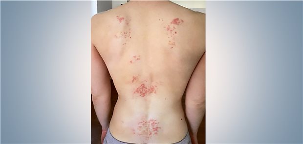 Juckende Papeln am Rücken: Was ist das?