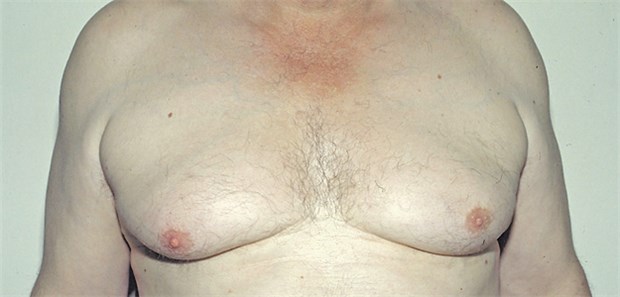 Müssen Männer zum Mamma-Screening? Gynäkomastie: Befindet sich ein Malignom in der Männerbrust?