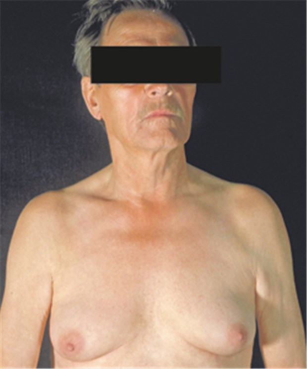 Androgen-Entzug ist bei Herzpatienten riskant Gynäkomastie bei kontrasexueller Therapie wegen Prostata-Ca: Bei Herzerkrankungen kann die Behandlung mehr schaden als nutzen.