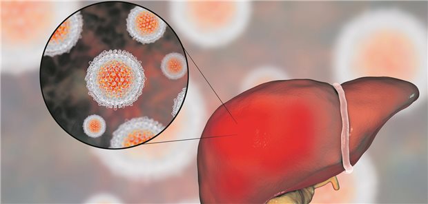 HCV-Infektion der Leber. Direkt antiviral wirkende Arzneien haben für einen Therapiedurchbruch gesorgt.