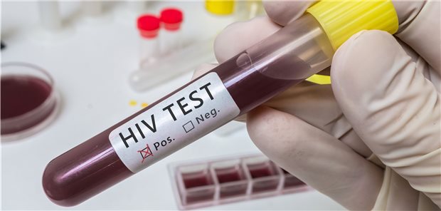 HIV-Diagnose: Über die Hälfte der jährlichen Neudiagnosen könnten früher gestellt werden.